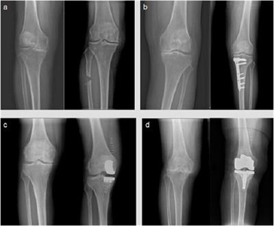 Therapeutic potential of nanotechnology-based approaches in osteoarthritis